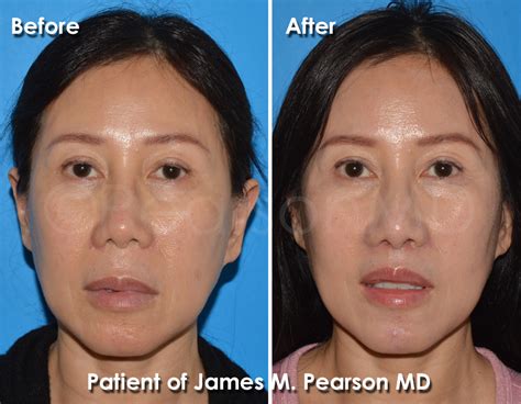 asia lip reduction before aftr.